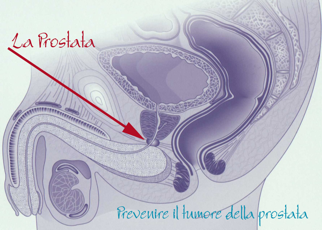 tumore della prostata prevenzione